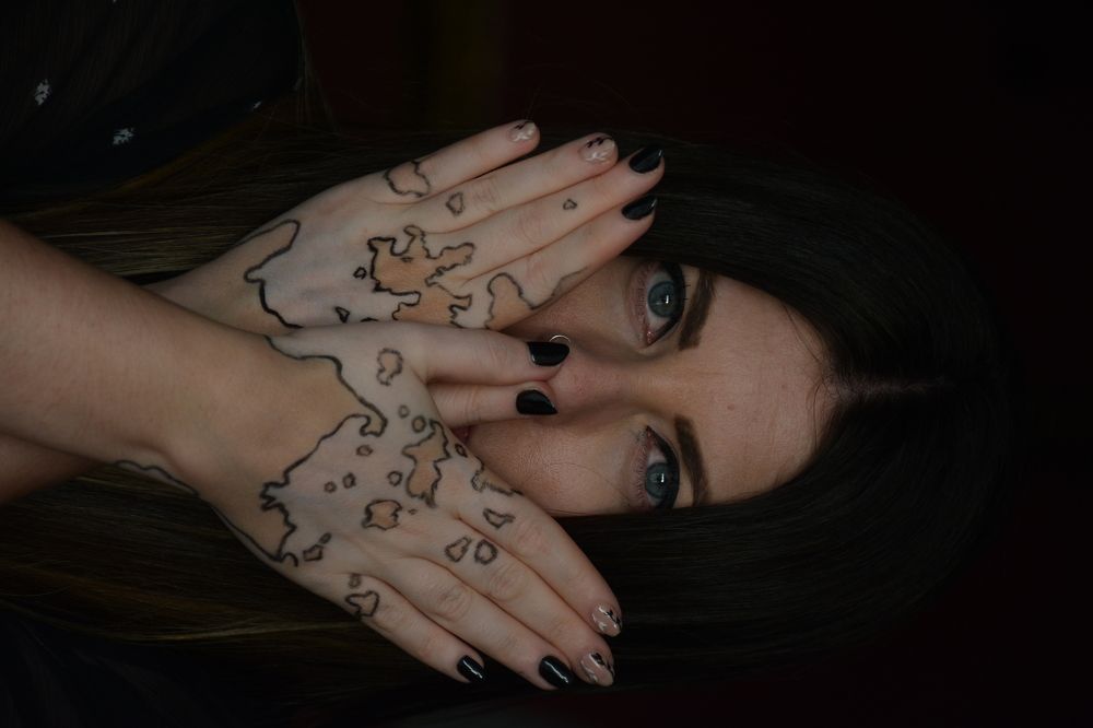 vitiligo female portrait