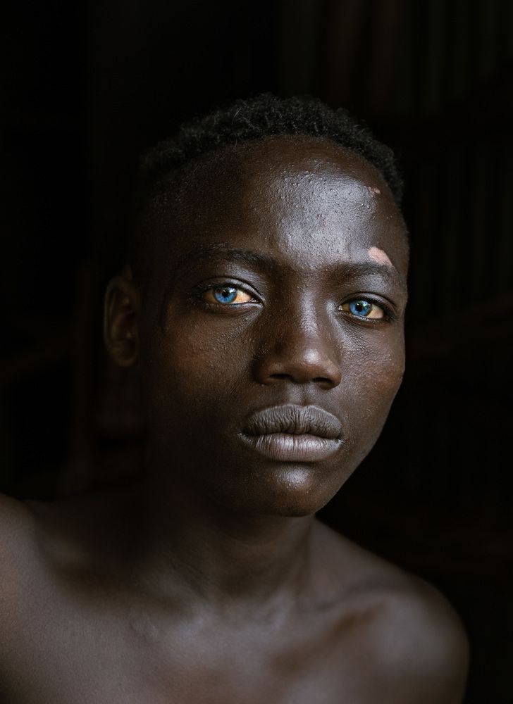 A blue-eyed Ethiopian boy