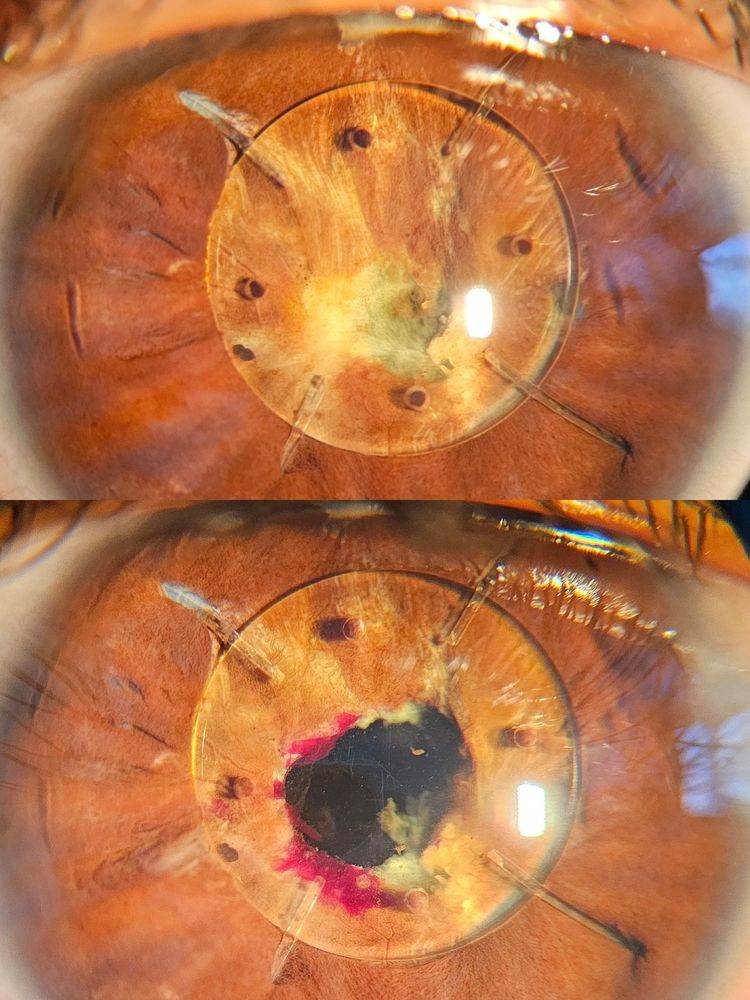 Before and after eye surgery