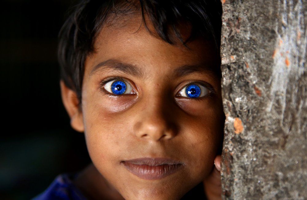 Child With Rare Eyes