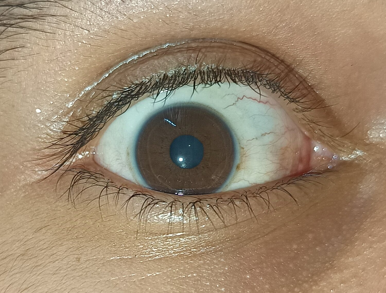 Eye