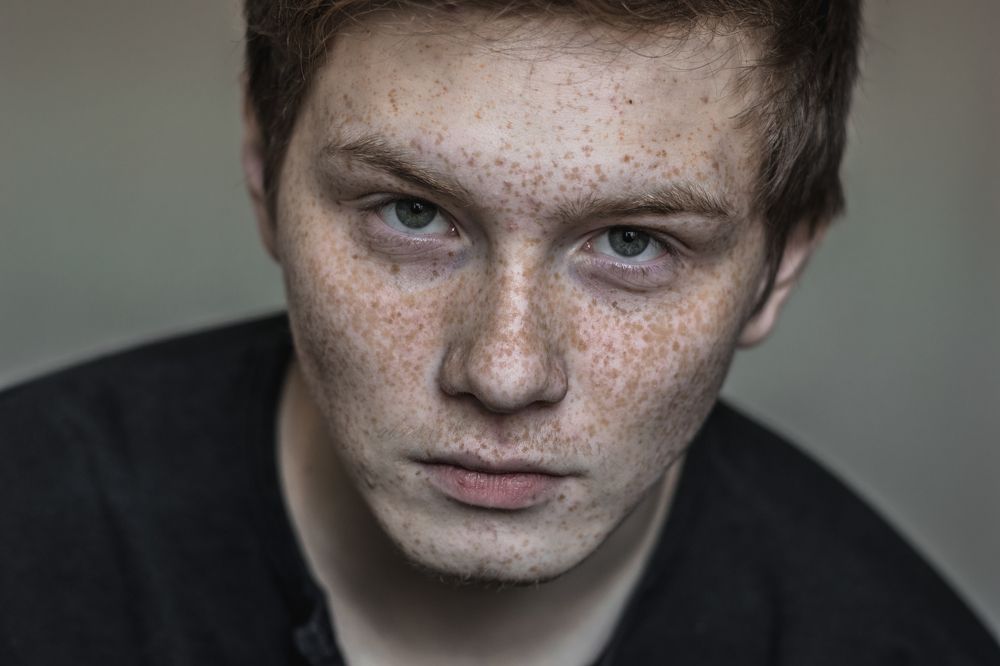 Человек с пятнами на лице