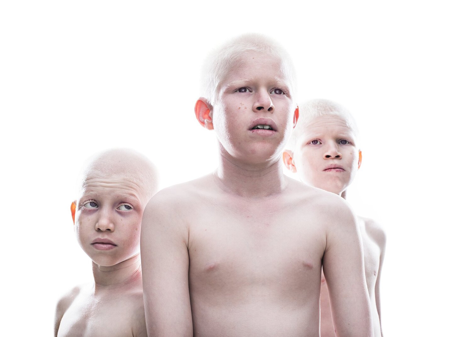 Albinism in India