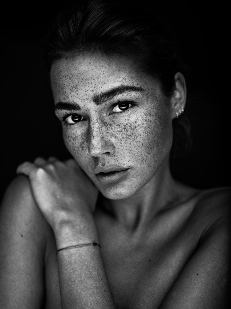 Freckles