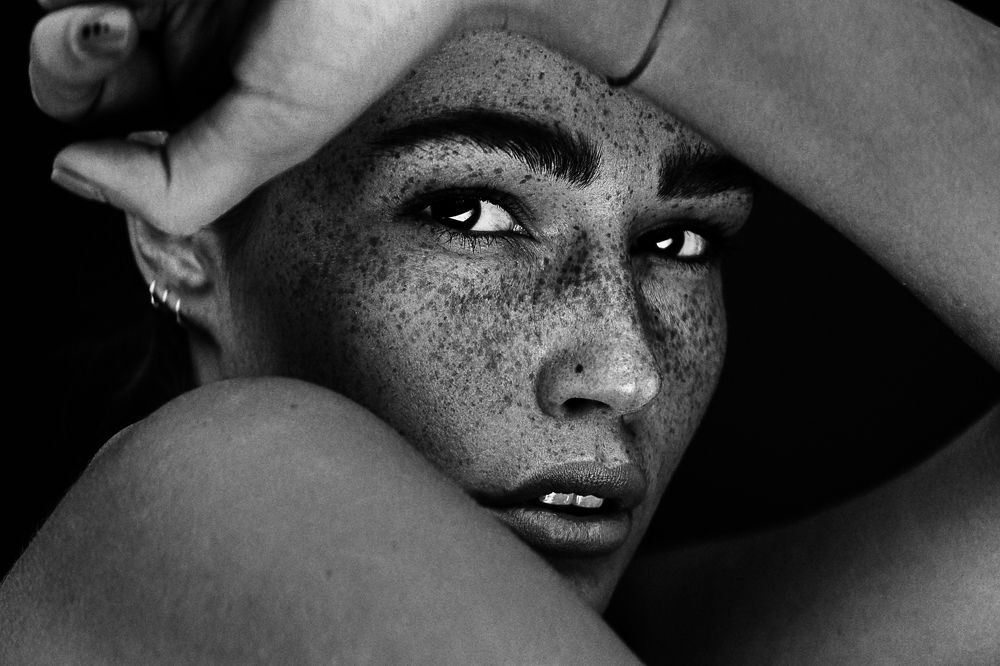Freckles