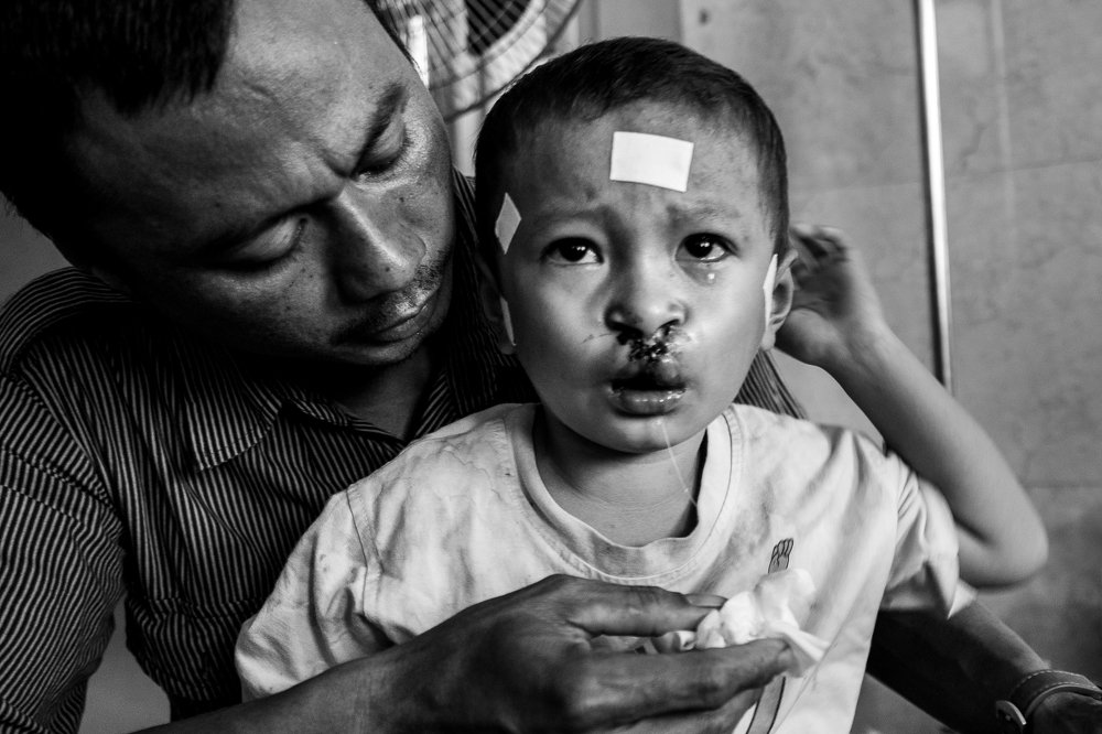 After cleft lip surgery