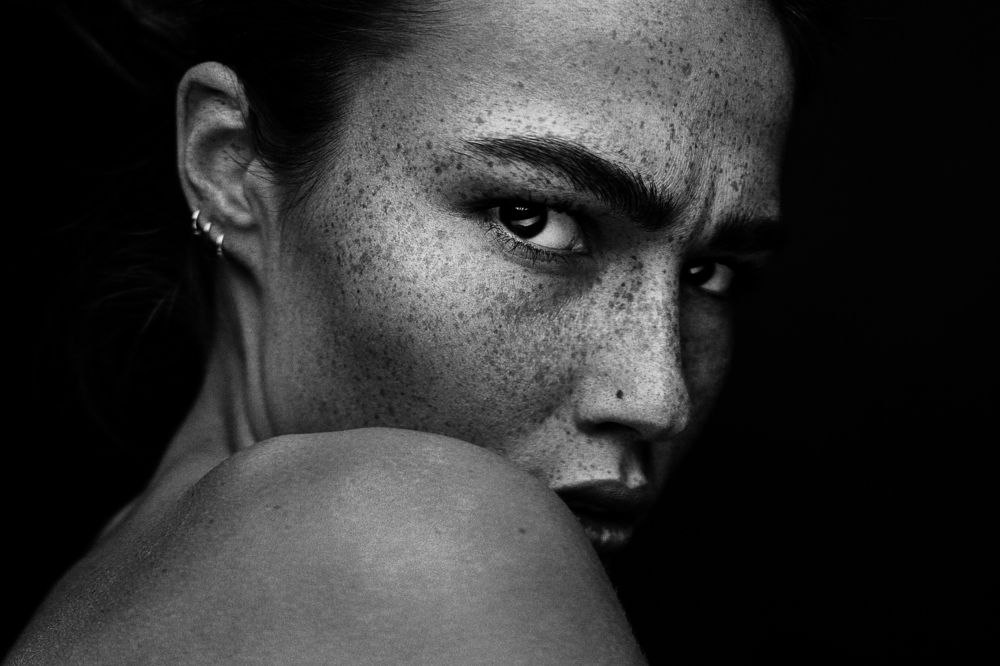 Freckles