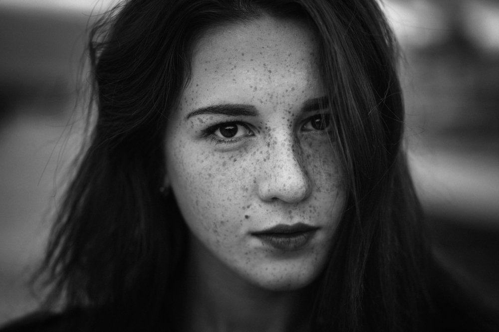 Freckles