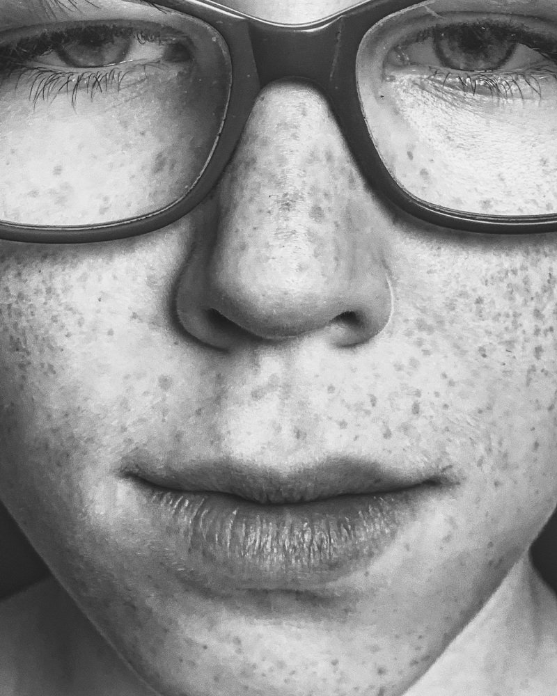 Freckle face